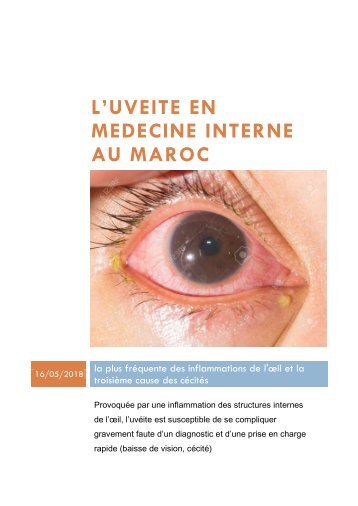 LES UVEITES EN MEDECINE INTERNE AU MAROC 