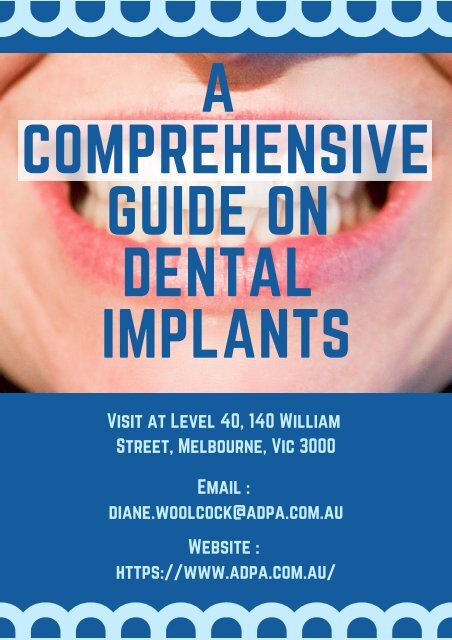 A Comprehensive Guide On Dental Implants