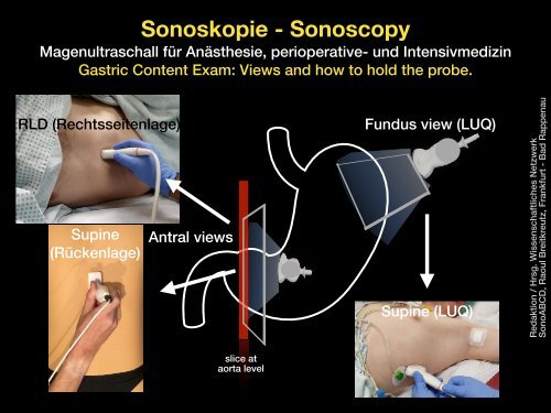 Magenultraschall - Gastric Content Exam