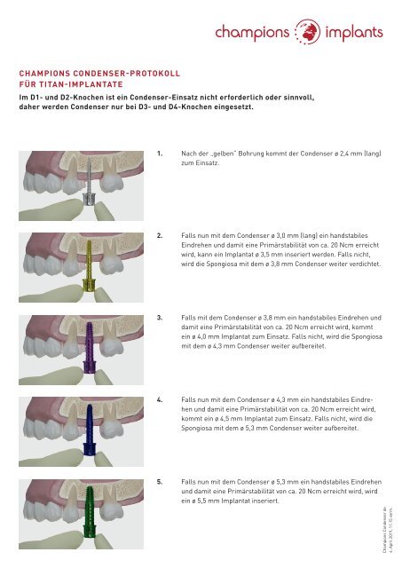 Champions Condenser-Protokolle für Titan- und BioWin! Implantate