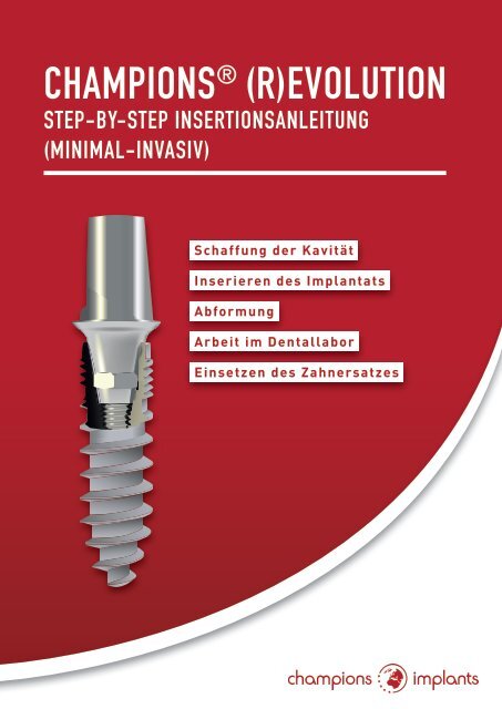 Step-by-Step Insertionsanleitung Champions (R)Evolution Implantate