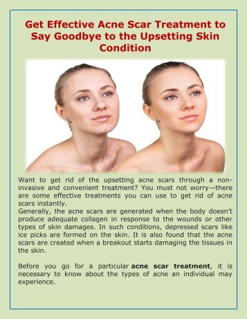  Get Acne Scar Treatment  And Say Goodbye To Acne Problems 