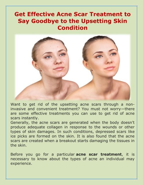  Get Acne Scar Treatment  And Say Goodbye To Acne Problems 