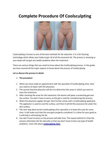 Complete-Procedure-Of-Coolsculpting