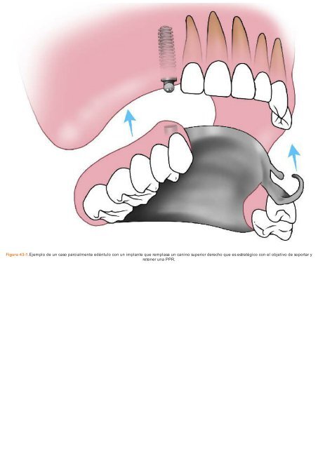 Periodoncia.e.Implantologia.Dental.de.Hall