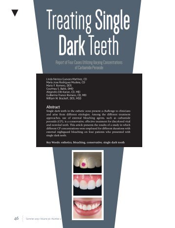 Treating Single Dark Teeth