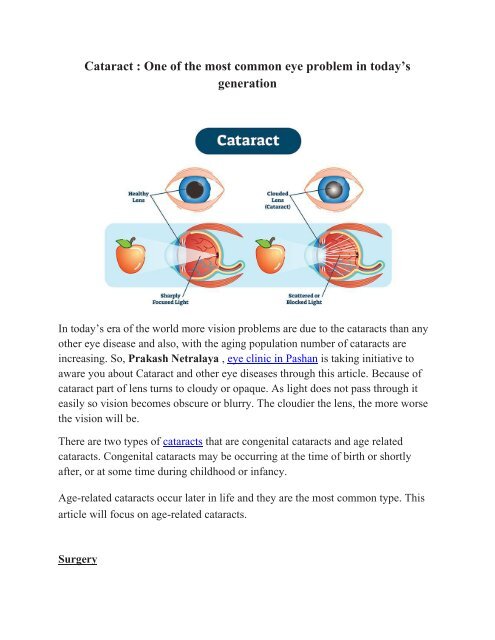 Cataract : One of the most common eye problem in today’s generation