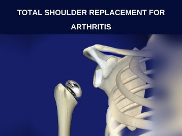 TOTAL SHOULDER REPLACEMENT FOR ARTHRITIS