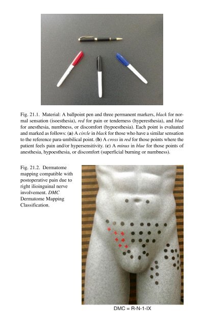 Brian P. Jacob, David C. Chen, Bruce Ramshaw, Shirin Towfigh (eds.) - The SAGES Manual of Groin Pain-Springer International Publishing (2016)