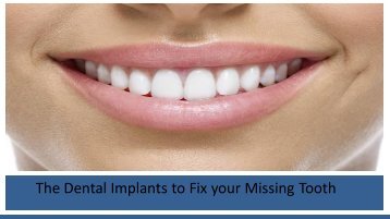 The Dental Implants to Fix your Missing Tooth