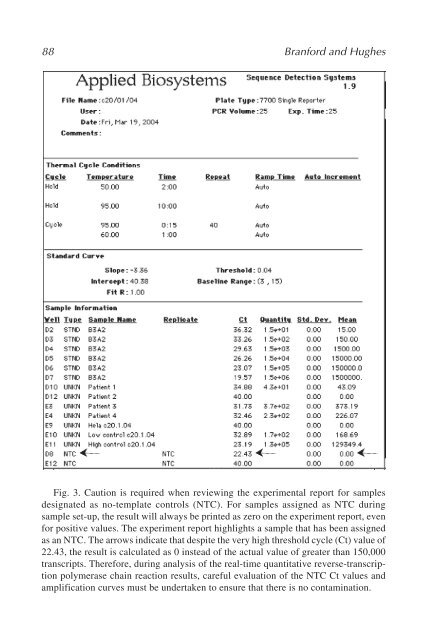 Myeloid Leukemia