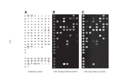 Myeloid Leukemia