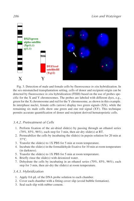 Myeloid Leukemia