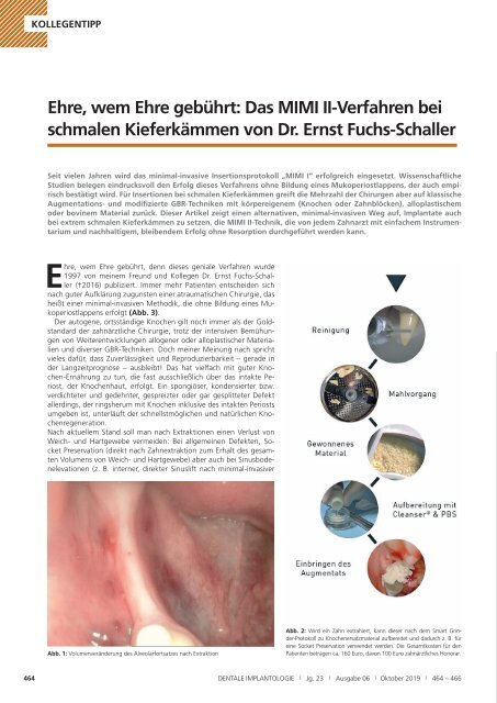 Ehre, wem Ehre gebührt: Das MIMI II-Verfahren bei schmalen Kieferkämmen von Dr. Ernst Fuchs-Schaller