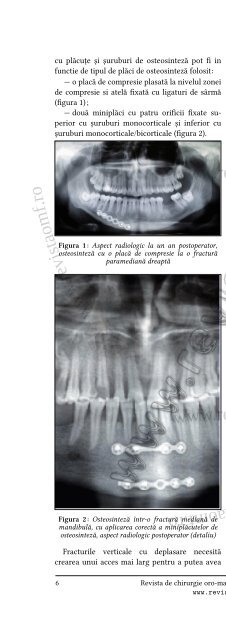 Fractura procesului coronoid al mandibulei—prezentare de caz și ...