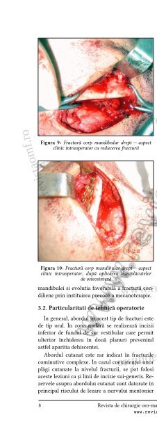 Fractura procesului coronoid al mandibulei—prezentare de caz și ...