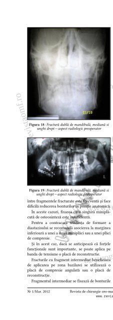 Fractura procesului coronoid al mandibulei—prezentare de caz și ...