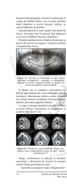 Fractura procesului coronoid al mandibulei—prezentare de caz și ...