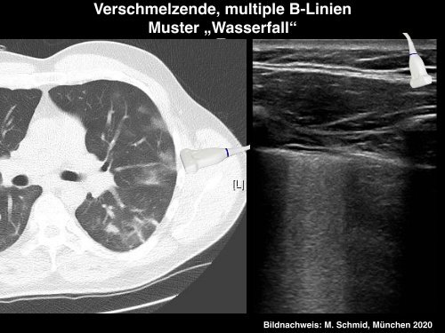 COVID-19 Lungensonographie: Untersuchungsmethoden und Befunde