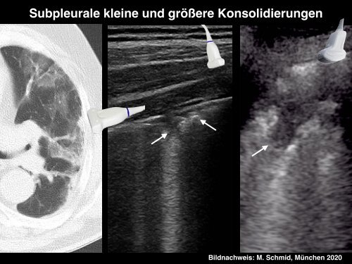 COVID-19 Lungensonographie: Untersuchungsmethoden und Befunde