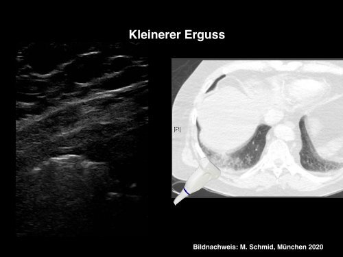 COVID-19 Lungensonographie: Untersuchungsmethoden und Befunde