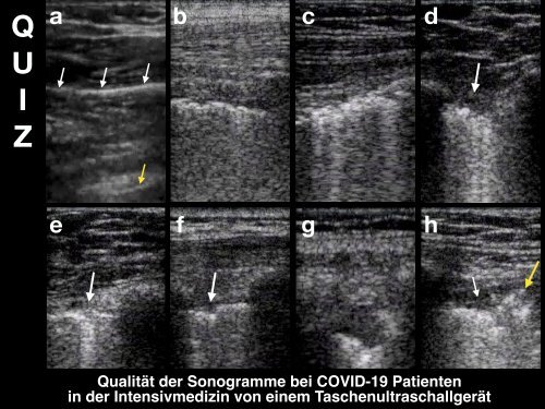 COVID-19 Lungensonographie: Untersuchungsmethoden und Befunde