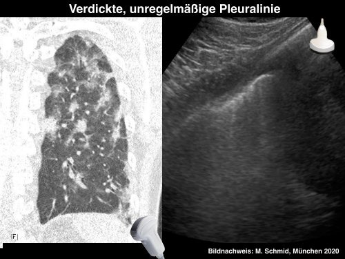 COVID-19 Lungensonographie: Untersuchungsmethoden und Befunde