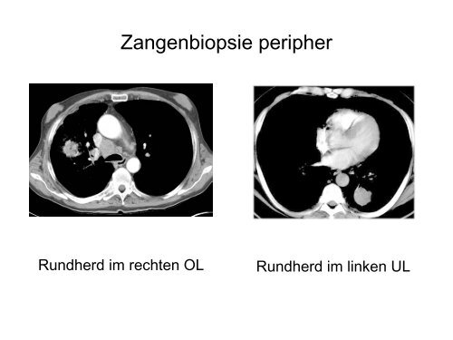 Zangenbiopsie