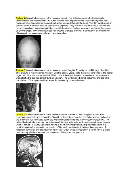 Anemia of Prematurity - Portal Neonatal