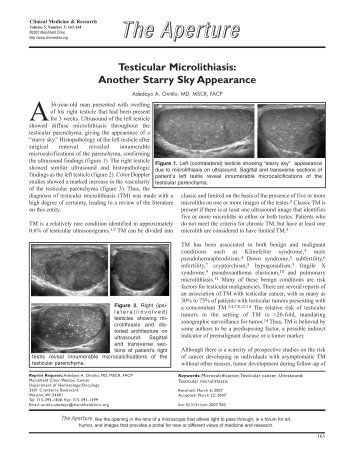 Testicular Microlithiasis: Another Starry Sky Appearance - Clinical ...