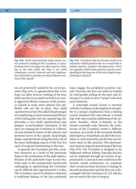 Refractive Lens Surgery