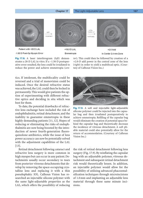 Refractive Lens Surgery