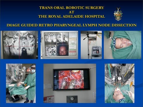 Trans-Oral Robotic Surgery - The Royal Adelaid - Global Robotics ...