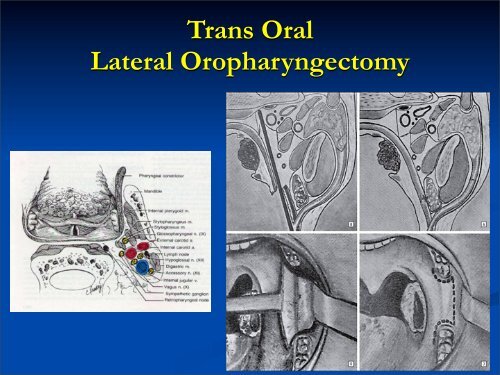 Trans-Oral Robotic Surgery - The Royal Adelaid - Global Robotics ...