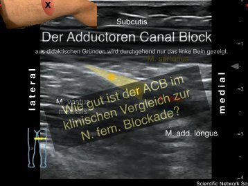 Der Adductoren Canal Block (ACB)