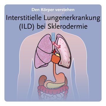 Interstitielle Lungenerkrankung (ILD) bei Sklerodermie