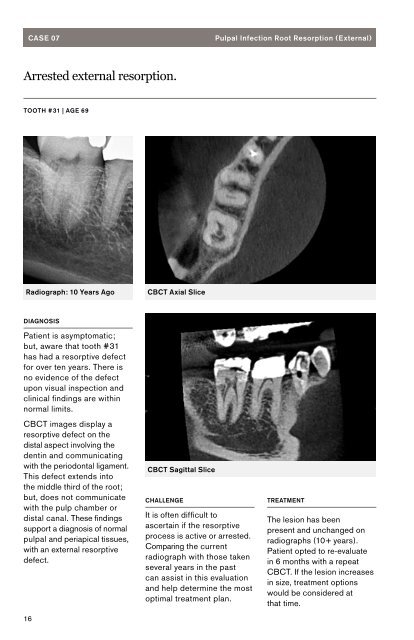 Portfolio 02: The Challenge Surrounding Tooth Resorption