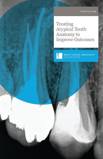 Portfolio 04: Treating Atypical Tooth Anatomy to Improve Outcomes