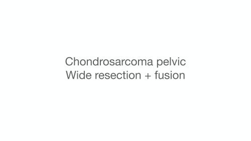 Chondrosarcoma pelvic Wide resection + fusion 