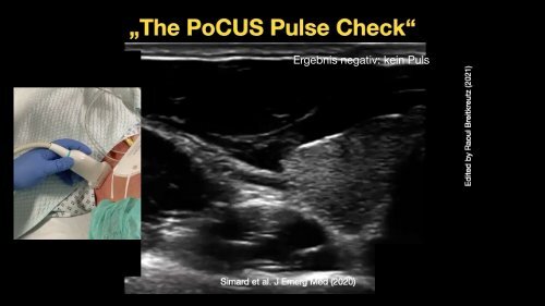 "The PoCUS Pulse Check" - oder doch lieber auf das Herz schauen?