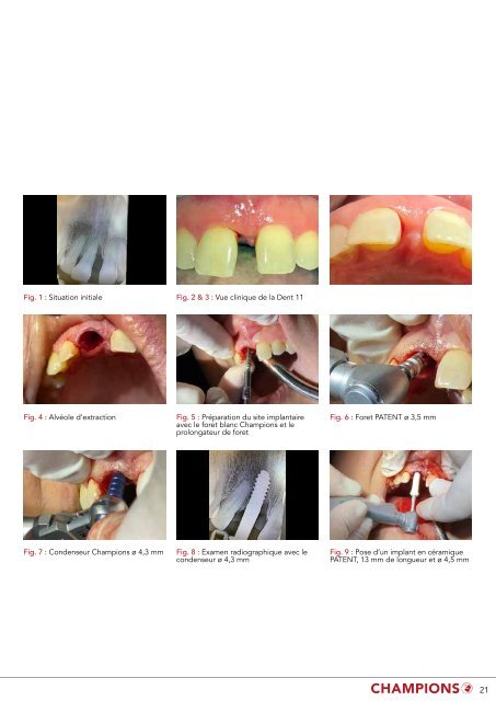 Catalogue produits – Implants en zircone "Patent"