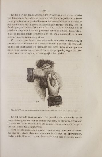 Cuando el parafimosis sea asiento de una gran inflamacion, el