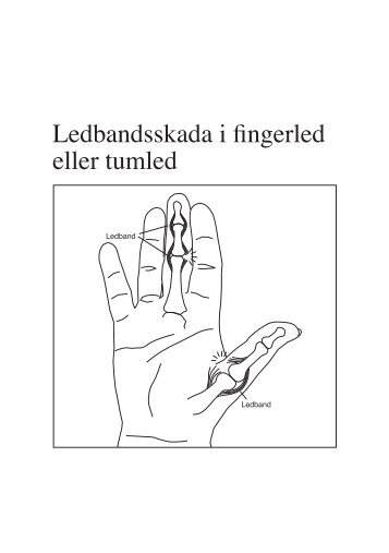 Ledbandsskada i fingerled eller tumled