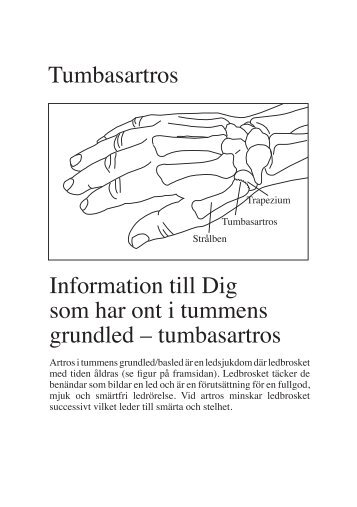 Tumbasartros Information till Dig som har ont i tummens grundled ...