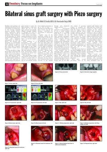 Focus on implants - Nobel Biocare