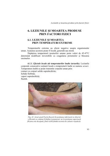 6. leziunile şi moartea produse prin factori fizici - Expert Medico ...