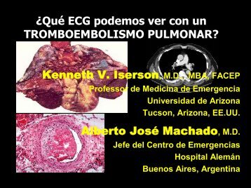 ¿Qué ECG podemos ver con un TROMBOEMBOLISMO PULMONAR?