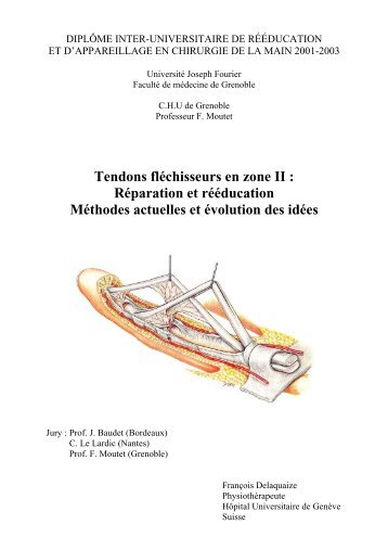 Tendons fléchisseurs en zone II : Réparation et rééducation ...