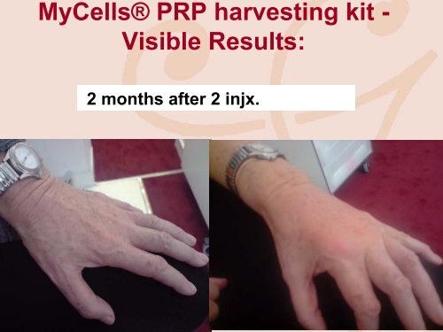 MyCells® - Platelet Rich Plasma harvesting kit : from ... - My-cells.net