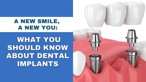 A New Smile, A New You: What You Should Know About Dental Implants
